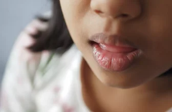 How Can I Prevent and Treat Dry, Cracked Lips?